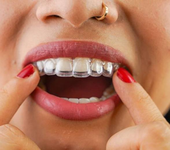 Close-up of woman’s mouth as she is placing clear aligner on teeth