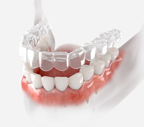 Illustration of clear aligner being placed on teeth