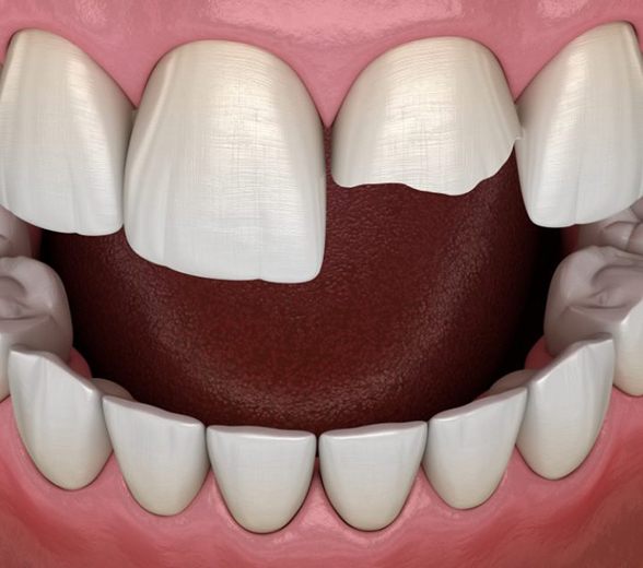 Model of a chipped front tooth