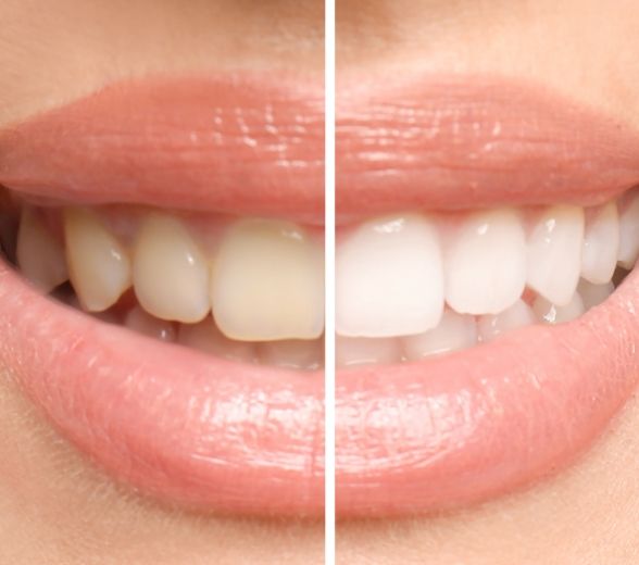 Smile before and after teeth whitening