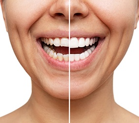 Close up of smile before and after cosmetic dentistry treatment