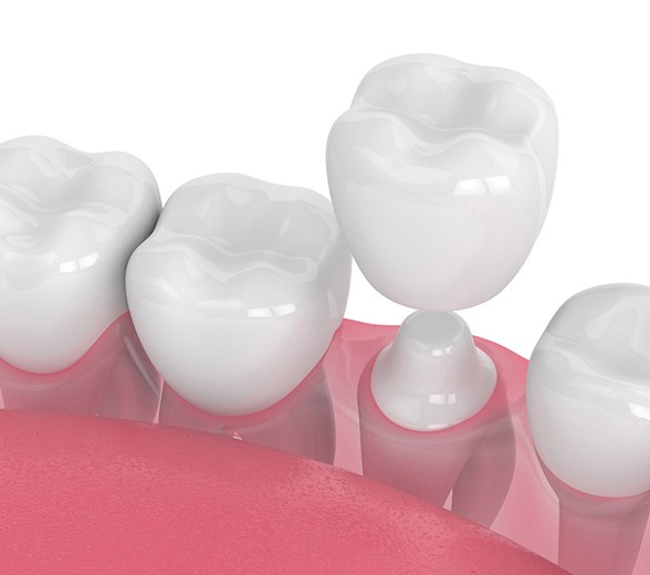 Illustrated model of a dental crown in Greenville being placed onto a tooth