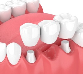 Illustration traditional dental bridge supported by natural teeth