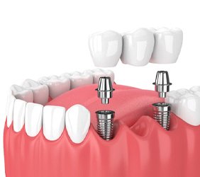 illustration implant dental bridge in Greenville