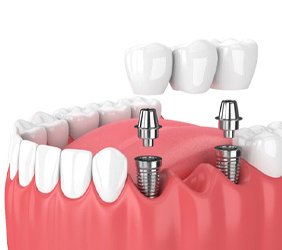 Illustration of dental implant bridge