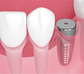 Digital illustration of dental implant