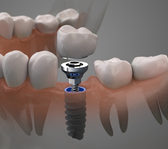 Animated model of a dental implant in Greenville with a dental crown