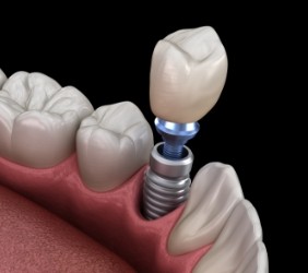 Animated dental crown being placed onto a dental implant