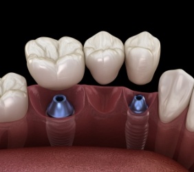 Animated dental bridge being placed onto two dental implants