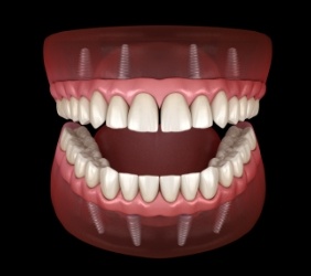 Animated model of implant denture
