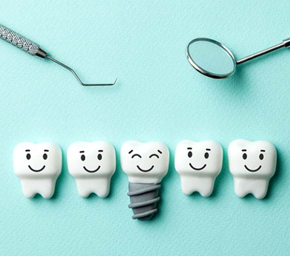 Illustration of several smiling teeth and one dental implant