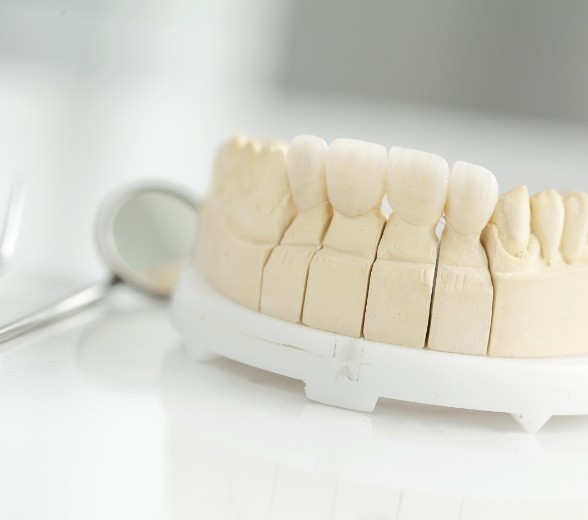 Model of the mouth with a dental bridge replacing missing teeth
