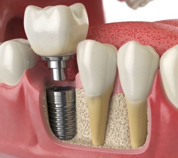 Animated smile with dental implant and dental crown