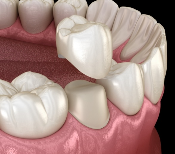 Animated dental crown being placed over a tooth