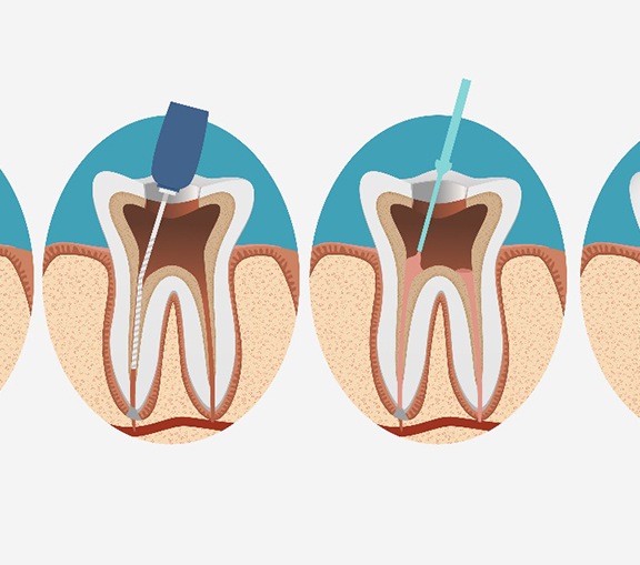 illustration for root canal therapy in Greenville 