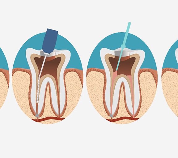 Illustration of the root canal process