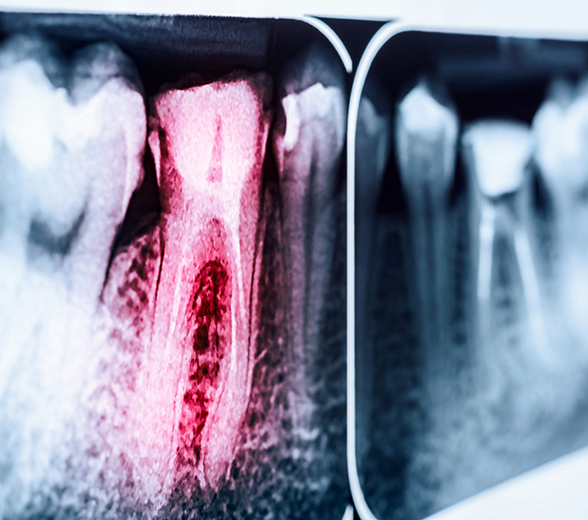 X ray of a tooth highlighted red