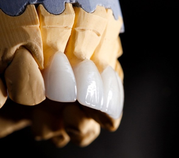 Veneers on a set of model teeth