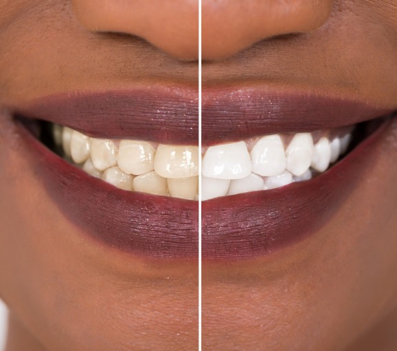 Close up of smile before and after teeth whitening in Greenville