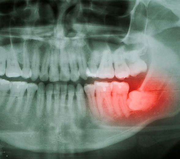 Dental X-ray showing impacted wisdom tooth