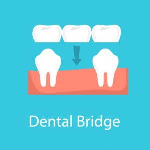 dental bridge illustration 