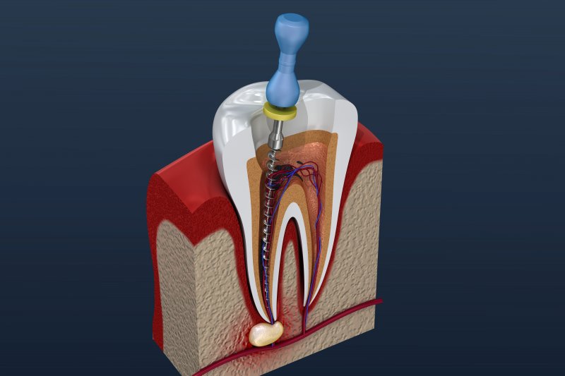 3-D diagram of a root canal