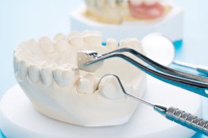 Sample dental crown placed on model tooth